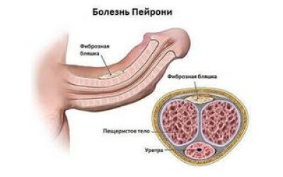 Почему уменьшается половой член и что с этим делать