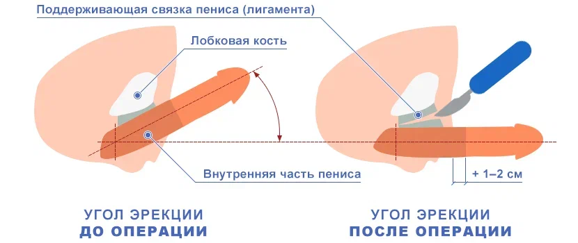 Операции по удлинению и утолщению полового члена