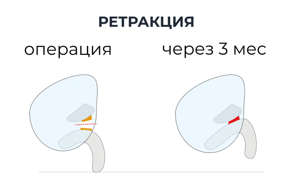 ligamentotomiya retrakciya