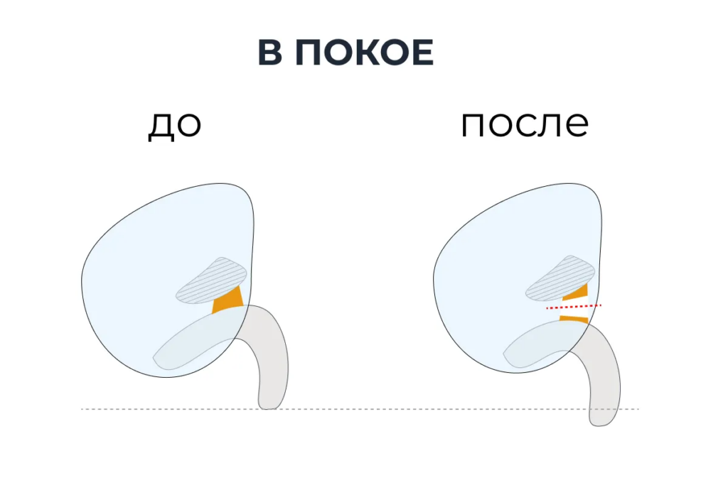 ligamentotomiya rezultat v pokoe